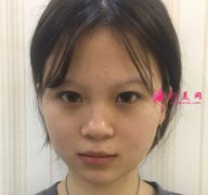 廈門安黛美醫(yī)療美容雙眼皮怎么樣？真人案例分享