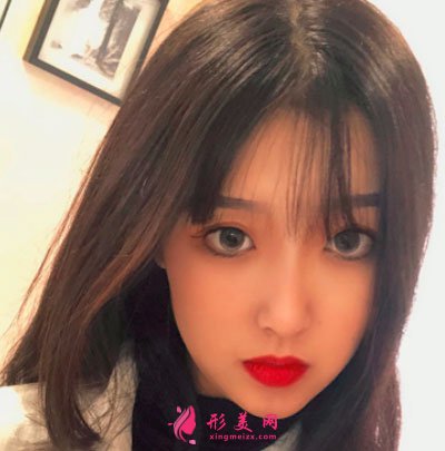 寧波靜港整形自體脂肪面部填充案例