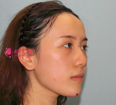 寧波薇琳醫(yī)療美容醫(yī)院肋軟骨隆鼻案例