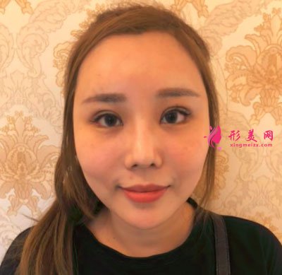 天津圣韓美醫(yī)療美容鼻部多項案例