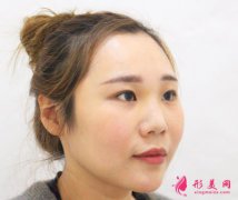天津圣韓美醫(yī)療美容鼻綜合，術(shù)后3個月真人案例分享