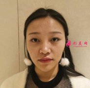 昆明藝星醫(yī)療美容醫(yī)院鼻部多項(xiàng)案例分享