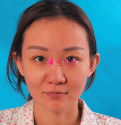 北京美萊醫(yī)療美容醫(yī)院鼻部多項(xiàng)手術(shù)案例