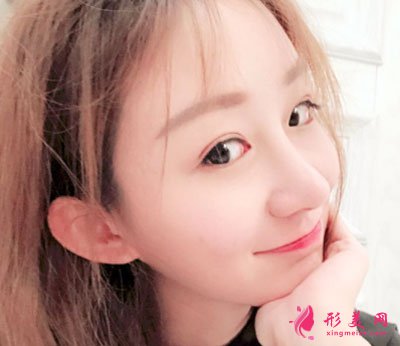 北京美萊醫(yī)療美容醫(yī)院鼻部多項(xiàng)手術(shù)案例