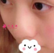 北京301郭伶俐做鼻子好不好？術(shù)后一年恢復(fù)記錄