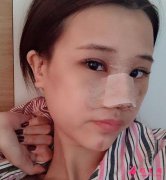 浙醫(yī)二院隆鼻怎么樣？真人案例在線反饋這效果你i了嗎？