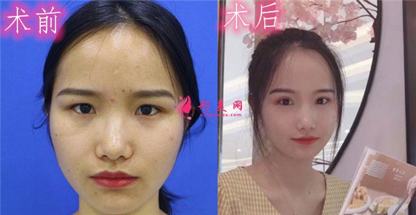 廈門安黛美醫(yī)療美容醫(yī)院張俠醫(yī)生案例