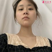 做一次玻尿酸墊下巴，魅力無窮
