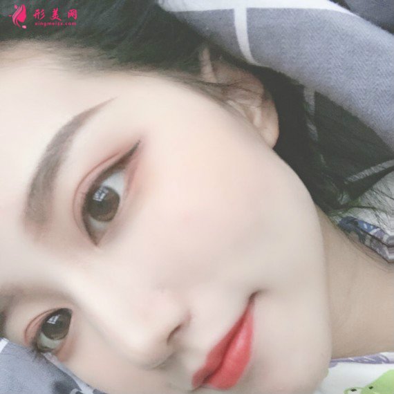 長沙美容院自體脂肪面部填充和假體豐下巴整形日記