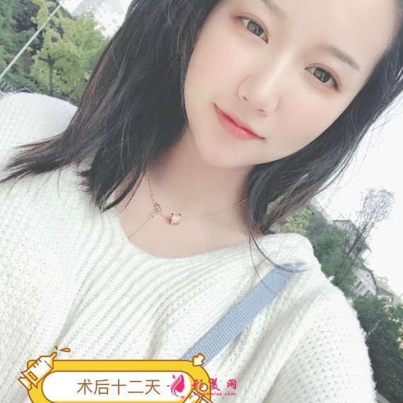 長沙美容院自體脂肪面部填充和假體豐下巴整形日記