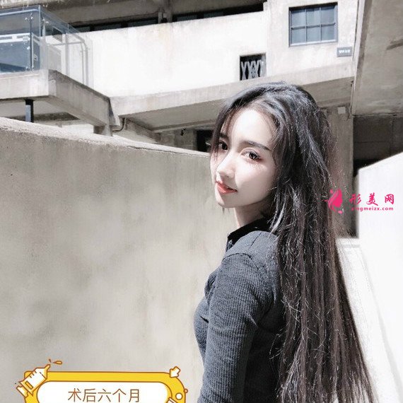 長沙美容院自體脂肪面部填充和假體豐下巴整形日記
