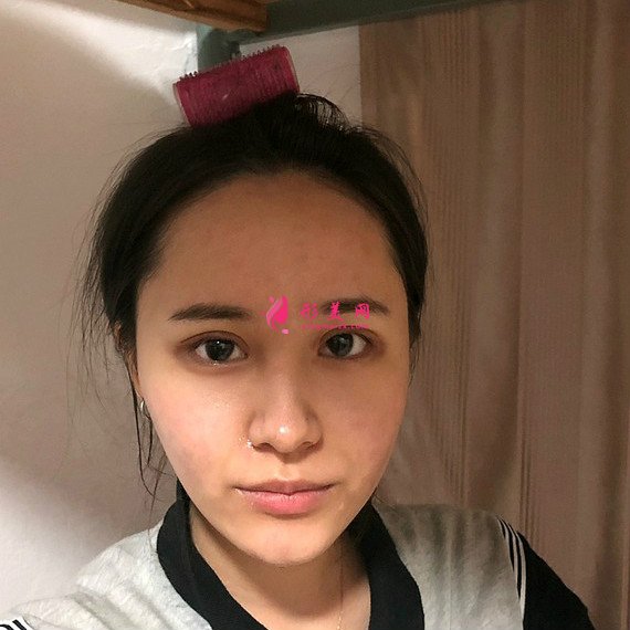 重慶美禪整形醫(yī)院做的全切雙眼皮效果還不錯