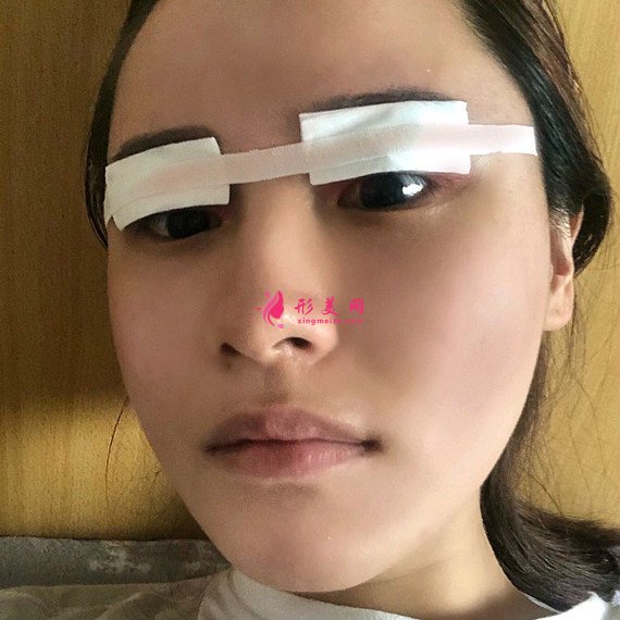 重慶美禪整形醫(yī)院做的全切雙眼皮效果還不錯