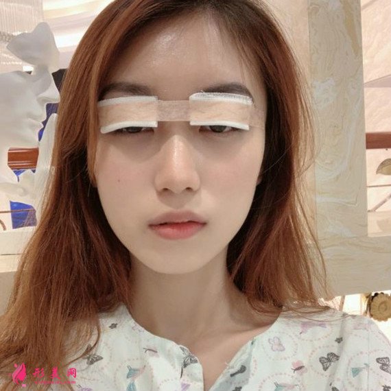 做了全切雙眼皮手術后再也不用麻煩的雙眼皮貼了