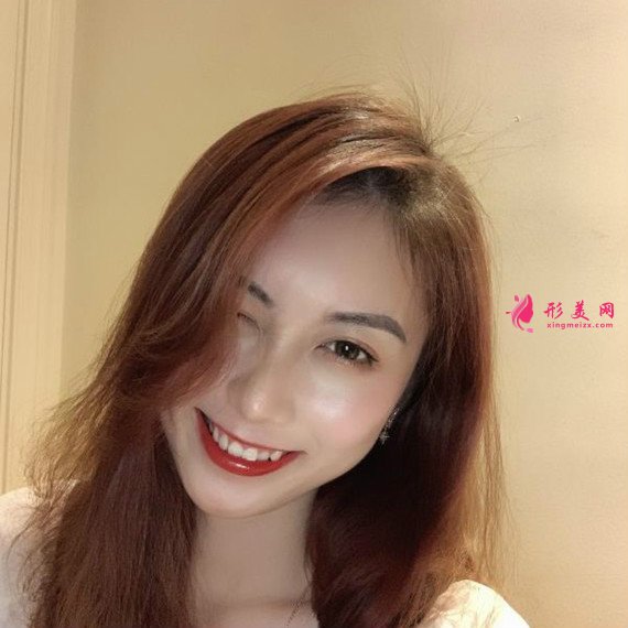 做了全切雙眼皮手術后再也不用麻煩的雙眼皮貼了