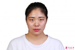 上海九院蘇薇潔雙眼皮怎么樣？術(shù)后效果呈現(xiàn)