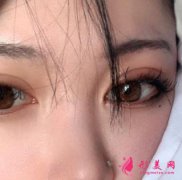 八大處宋濤雙眼皮修復(fù)怎么樣？案例效果親身體驗