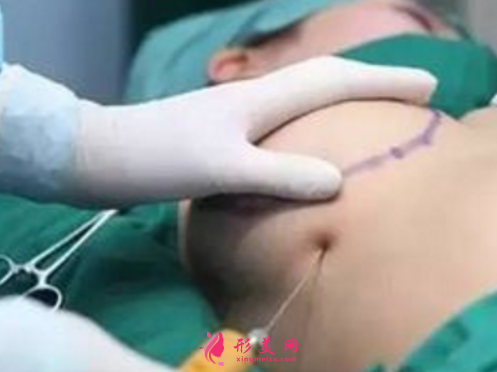 自體脂肪隆胸需要注意的風(fēng)險(xiǎn)問題