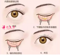 手術(shù)祛眼袋術(shù)后有哪些注意事項？