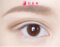 做雙眼皮手術(shù)會(huì)有疤痕出現(xiàn)嗎？