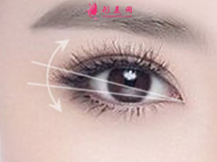 做開眼角手術(shù)會(huì)影響視力嗎？