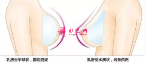 假體隆胸多久可以上班