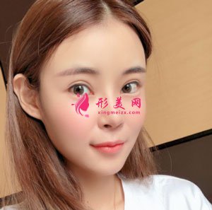 南京美貝爾整形醫(yī)院自體脂肪面填案例