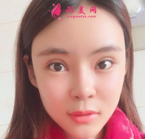 南京美貝爾整形醫(yī)院自體脂肪面填案例