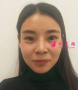 南京美貝爾找黃名斗做的自體脂肪面部填充，術(shù)后一百天案例分享