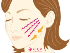 面部埋線后多久消腫？