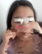 北京雙眼皮修復(fù)多少錢？看我在北京京明做的修復(fù)案例