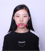 鄭大一附院李廣帥做雙眼皮怎么樣？案例圖集高清上線！