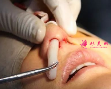 隆鼻假體取出費(fèi)用是多少？