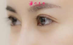 切開雙眼皮多久后消腫