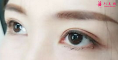 雙眼皮整形手術的效果可以保持多久？