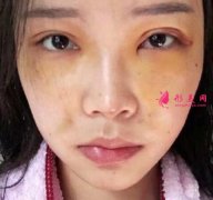 揚(yáng)州蘇北人民醫(yī)院整形科做了面部填充，效果分享