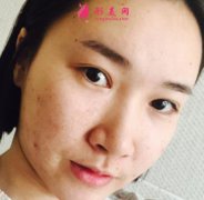 濟(jì)南星范整形鼻綜合效果好嗎？真人案例一覽