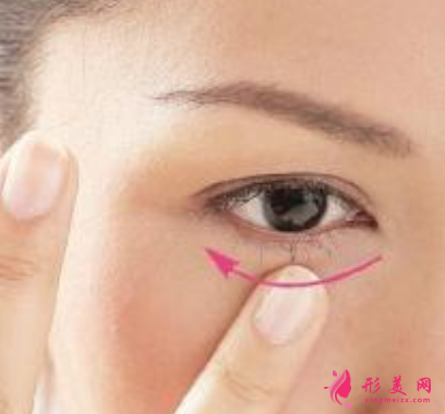 手術(shù)切除眼袋后多久恢復(fù)好