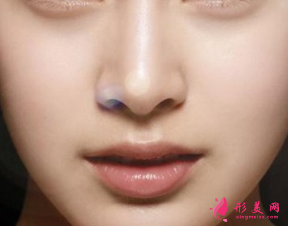 假體隆鼻后能保持多久