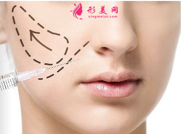 廣州哪里做玻尿酸填充比較好