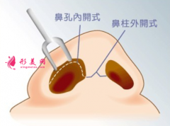 廣州哪里做鼻翼縮小整形好