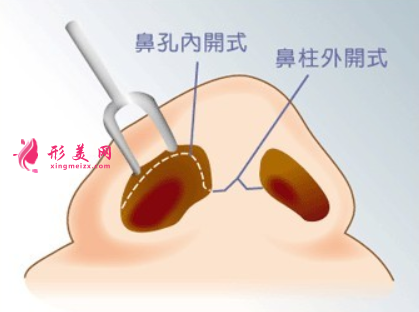 廣州哪里做鼻翼縮小整形好