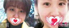 沈陽伊美爾的周韋宏做雙眼皮怎么樣？術(shù)后眼睛漂亮了很多