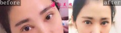 沈陽伊美爾雙眼皮好嗎？術(shù)后60天真人案例分享