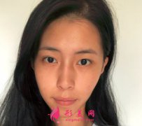 武漢歐尚美的王大山做的鼻部多項效果怎么樣？術(shù)后真人案例分享