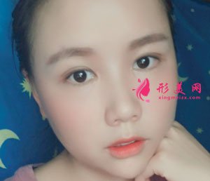 重慶時(shí)光整形美容醫(yī)院切開雙眼皮案例