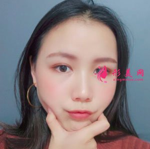 重慶時(shí)光整形美容醫(yī)院切開雙眼皮案例