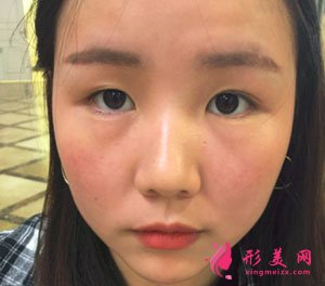 重慶時(shí)光整形美容醫(yī)院切開雙眼皮案例