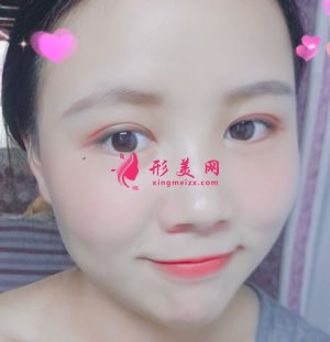 重慶時(shí)光整形美容醫(yī)院切開雙眼皮案例