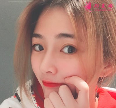 南京美貝爾整形醫(yī)院手術(shù)縮鼻翼案例